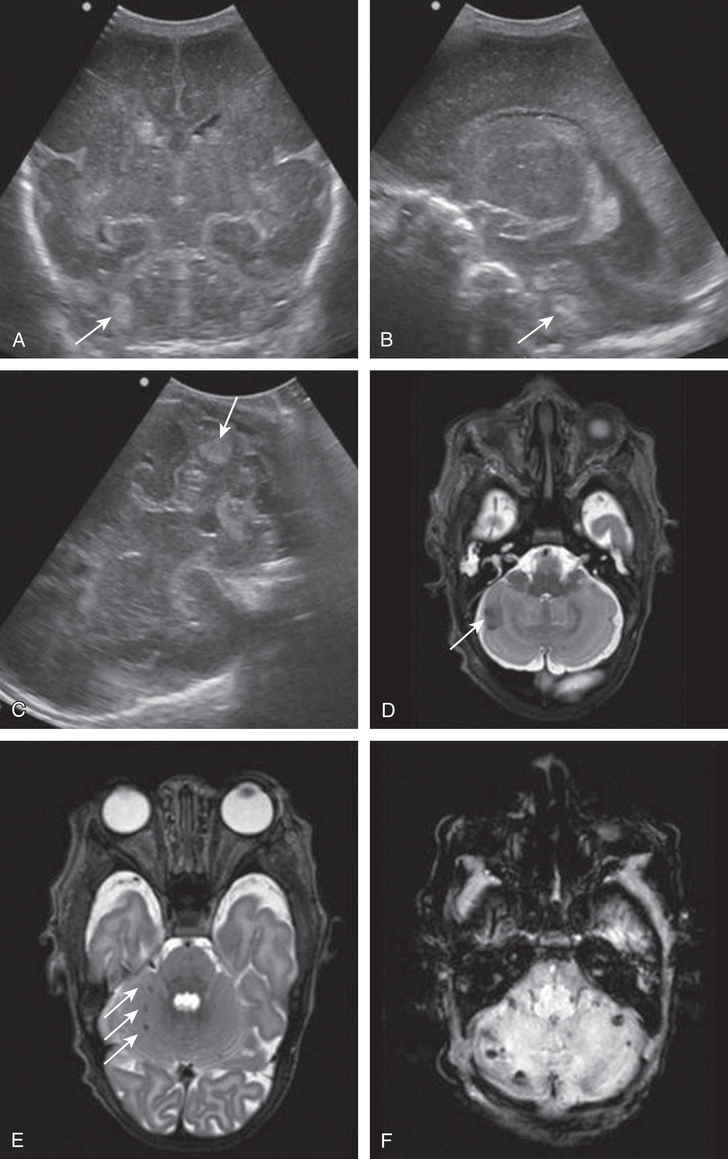 Fig. 27.9, Preterm infant (gestational age 26 weeks), cranial ultrasound performed at fourth postnatal day. (A) Coronal view through anterior fontanel shows bilateral intraventricular hemorrhage and echogenicity in the right cerebellar hemisphere (arrow) . (B) Parasagittal view shows the small intraventricular hemorrhage and echogenicity within the right cerebellar hemisphere (arrow) . (C) Coronal view through the right mastoid fontanel clearly demonstrates the small convexity lesion in the right cerebellar hemisphere (arrow) . (D) Magnetic resonance (MR) image in the same infant, obtained at term age, shows the lesion (arrow) . (E) T2-weighted MR image shows convexity hemorrhage in the right cerebellar hemisphere and punctate hemorrhages in the right hemisphere not detected by ultrasound (arrows) . (F) Susceptibility-weighted image demonstrates multiple bilateral cerebellar hemorrhages.