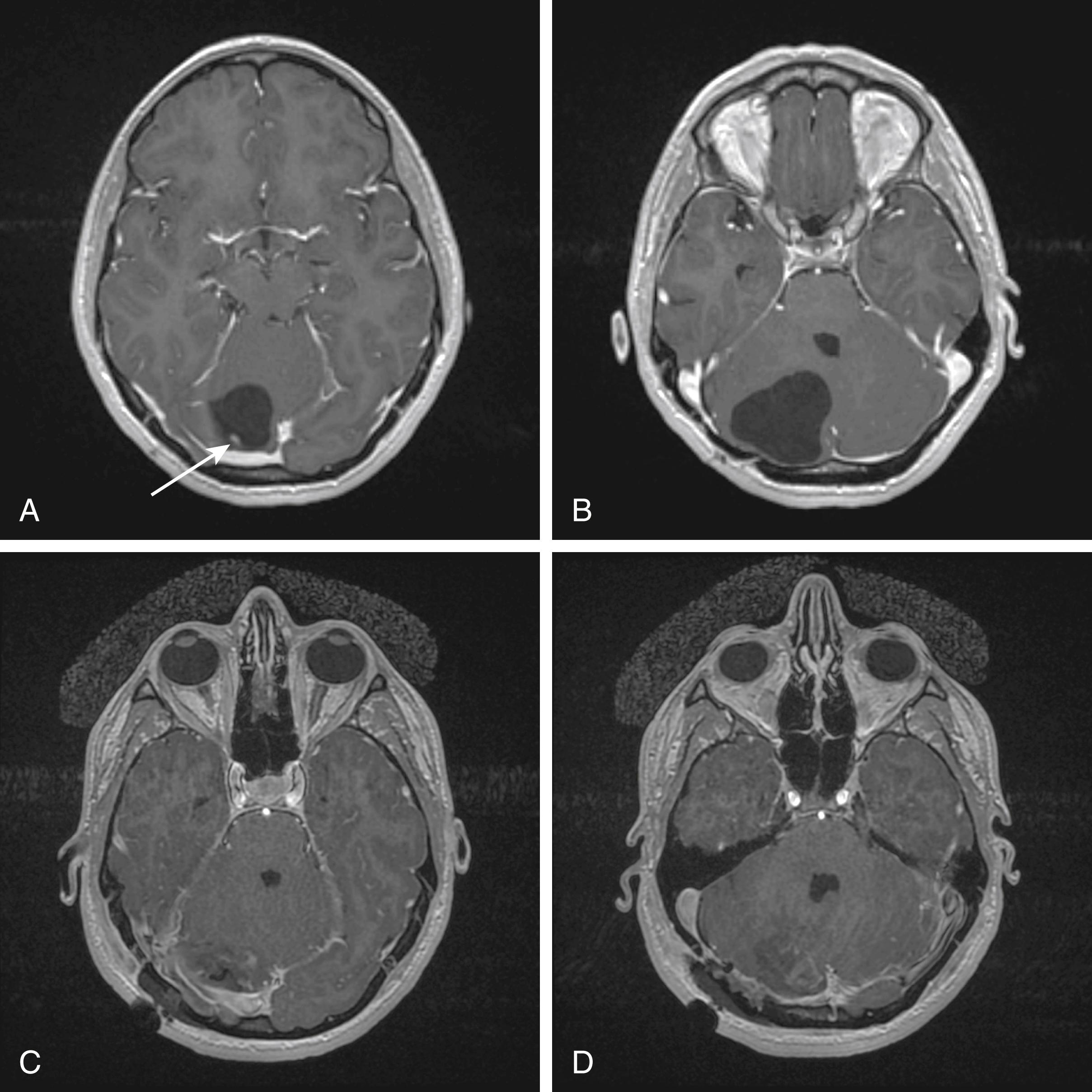 FIGURE 10.1, Hemangioblastoma. (A) T1 magnetic resonance imaging (MRI) with gadolinium shows a hypointense cerebellar lesion with a small enhancing mural nodule (arrow) . (B) The lesion is primarily cystic, with minimal fourth ventricular effacement. (C and D) Postoperative T1-weighted gadolinium-enhanced MRI demonstrates gross total resection, including resection of the mural nodule.
