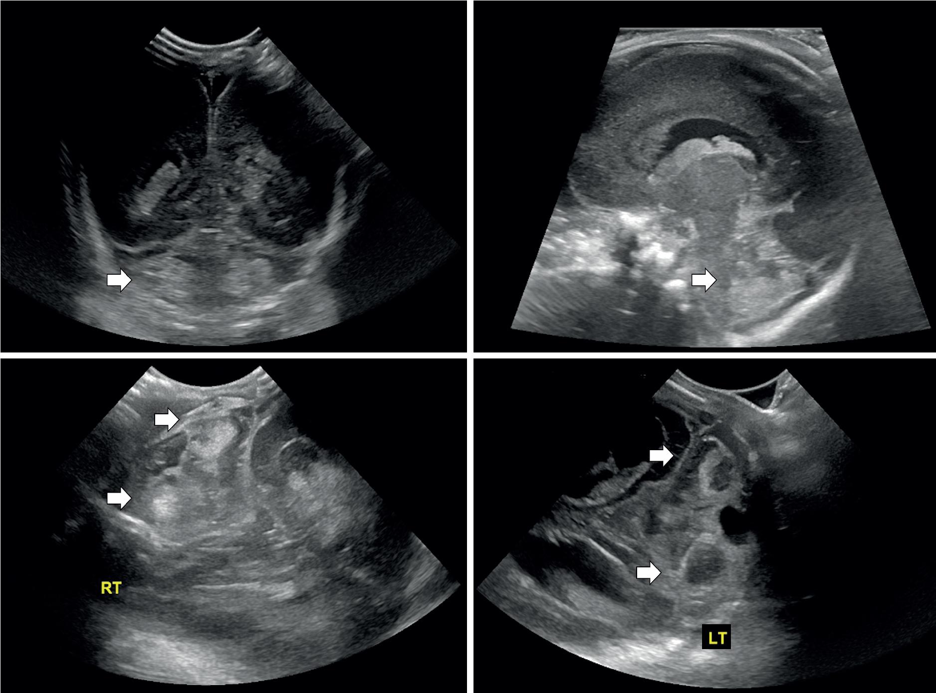 Fig. 5.1, Ultrasound images over time of the 24-week preterm male depicted in the case study. Upper left panel: Coronal image on day of life (DOL) 3 via the anterior fontanel demonstrating bilateral intraventricular hemorrhage within the posterior horns of the lateral ventricles with left periventricular hemorrhagic infarction and bilateral cerebellar hemisphere echogenicities suspicious for hemorrhage ( arrowhead ). Upper right panel: Sagittal right image on DOL 3 via the anterior fontanel demonstrating echogenicity within the inferior portion of the cerebellar hemisphere ( arrowhead ). Bottom left panel: Ultrasound image on DOL 6 via the left mastoid fontanel demonstrating echogenicities within both cerebellar hemispheres suggestive of cerebellar hemorrhage ( arrowheads ). Ultrasound image on DOL 19 via the left mastoid fontanel demonstrating lesions with echogenic rims in both cerebellar hemispheres, likely representing the subacute phase of the cerebellar hemorrhages ( arrowheads ).