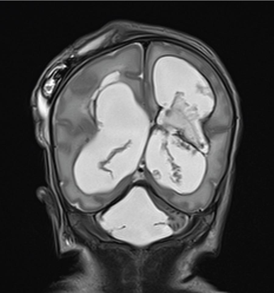 Fig. 5.2, Coronal T2 weighted MRI image of the 24-week preterm male depicted in the case study at 34 weeks postmenstrual age. The cerebellum is atrophic secondary to the early cerebellar hemorrhages. This patient also developed posthemorrhagic ventricular dilatation requiring a ventricular shunt and periventricular leukomalacia.