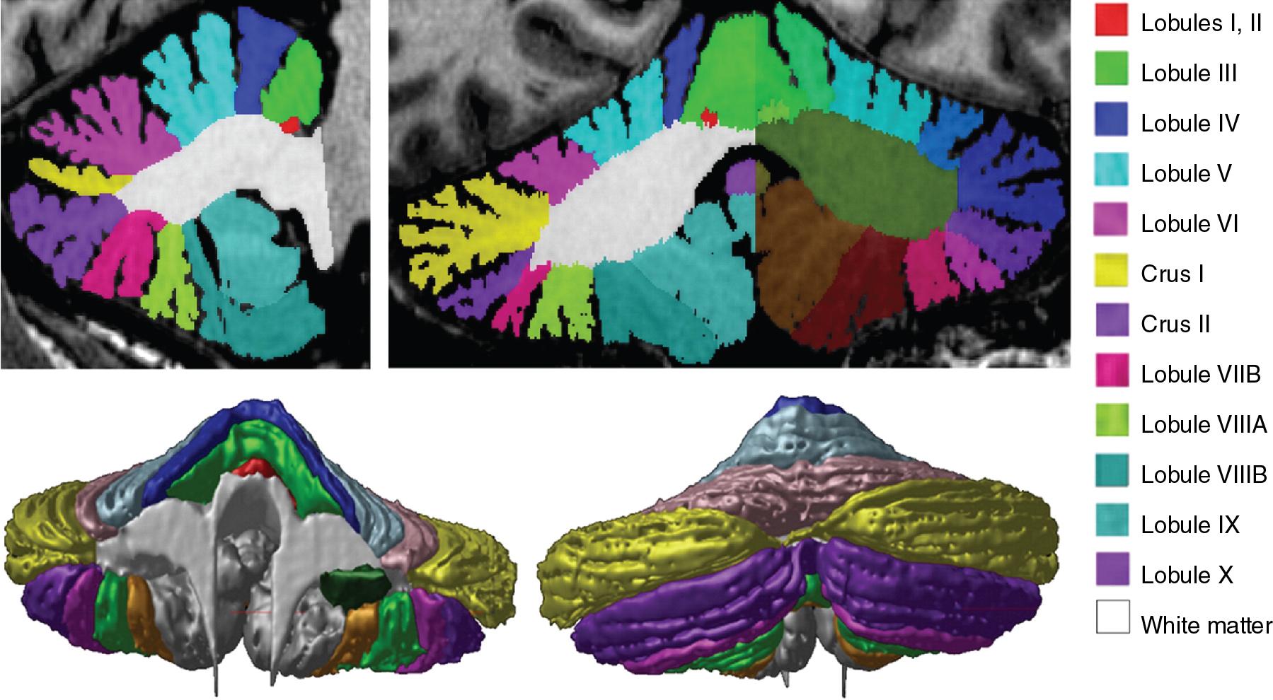 Fig. 5.4, Segmented MRI T1-weighted images of the adult cerebellum. Top panel: Cerebellar lobules defined according to fissures with the left and right hemispheres containing a different set of labels in a sagittal ( left ) and coronal ( right ) section. Bottom panel: 3D surface representation of the cerebellar lobules.