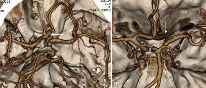 FIG 12-1, Reconstructed 3D CTA in a patient with polycystic kidney disease illustrating ( A, oblique view) a ruptured small, right anterior communicating aneurysm (arrow), and ( B, basal view) a hypoplastic left anterior cerebral artery A1 segment (arrow).