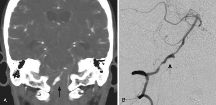 Fig. 12-11, Coronal reconstructed CTA image ( A ) of an intracranial dissecting right vertebral pseudoaneurysm (arrow). The right vertebral catheter cerebral angiogram, lateral oblique view ( B ), further evaluates the dissecting right vertebral pseudoaneurysm ( arrow) with adjacent proximal and distal arterial stenosis.