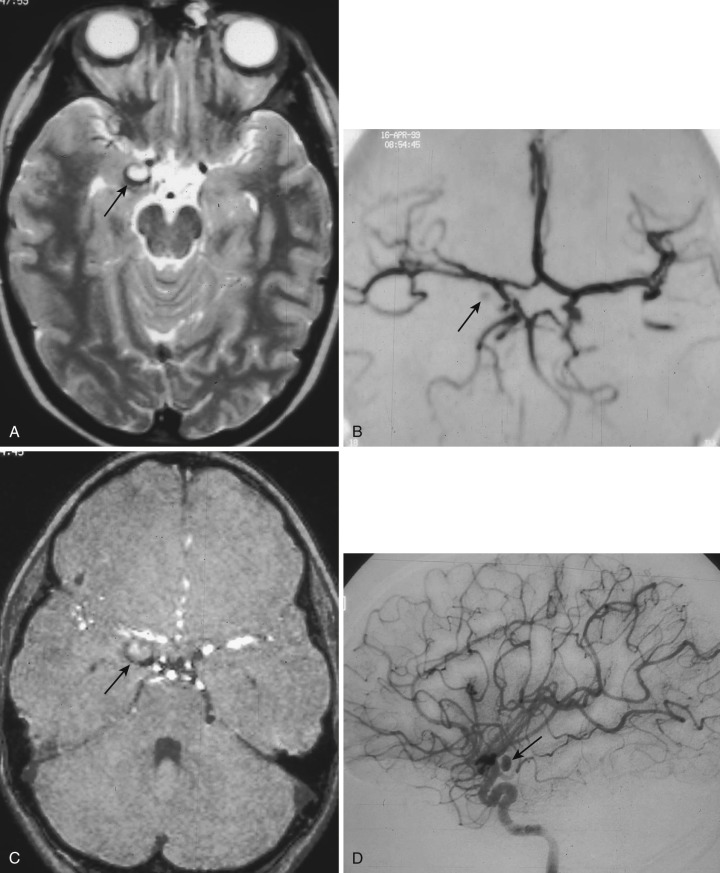FIG 12-12, A, Axial T2-weighted image demonstrates a mass with peripheral hemosiderin in the right temporal lobe uncus (arrow). B, Reconstructed collapsed MRA view does not depict the abnormality in the medial right temporal lobe well (arrow), although the source MRA image ( C ) does (arrow). D, Lateral view of the catheter right carotid cerebral angiogram documents the traumatic right anterior choroidal pseudoaneurysm (arrow). The pseudoaneurysm was absent on previous catheter cerebral angiography. Slow flow within the pseudoaneurysm accounted for its appearance on MRA.