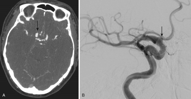 FIG 12-13, A, Axial CTA image of a ruptured right supraclinoid carotid blister aneurysm (arrow) in a patient with a previously surgically treated pituitary adenoma. B, AP oblique view illustrating the blister aneurysm (arrow) during Pipeline (Covidien Corp.) endovascular treatment.