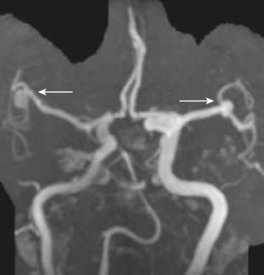 FIG 12-14, Rotated collapsed basal view of a noncontrast MRA illustrating small mirror middle cerebral aneurysms (arrows).