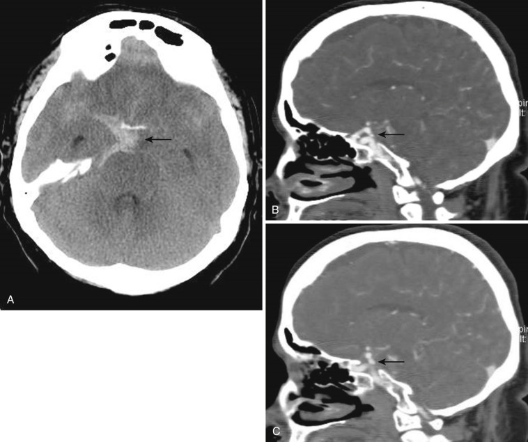 FIG 12-15, A, CT scan illustrating acute subarachnoid hemorrhage (arrow) centered in the expected location of a right posterior communicating aneurysm, confirmed on two contiguous sagittal reconstructed CTA images ( B and C, arrows ).