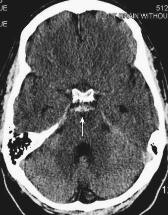 FIG 12-16, CT scan of a patient with benign perimesencephalic hemorrhage (arrow) and no cerebral aneurysm documented on catheter cerebral angiography.