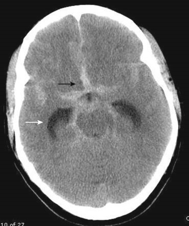 FIG 12-17, CT scan illustrating acute subarachnoid hemorrhage (black arrow) from a ruptured anterior communicating aneurysm presenting a star appearance in the basilar cisterns (same patient as in Fig. 12-1 ) and temporal horn enlargement indicating early communicating hydrocephalus (white arrow).