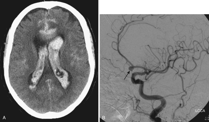 FIG 12-18, A, CT image demonstrating intraventricular hemorrhage as well as subarachnoid hemorrhage in a patient with a ruptured left anterior communicating aneurysm. B, The aneurysm is demonstrated on the oblique AP view of the catheter left carotid cerebral angiogram (arrow).