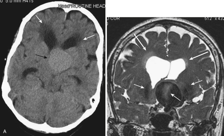 FIG 12-19, A, Axial noncontrast CT scan illustrates a large, mildly hyperdense mass (black arrow) at the level of the third ventricle, causing obstruction of the bilateral foramina of Monro and resulting in obstructive hydrocephalus with bilateral frontal horn and bilateral temporal horn enlargement. Note the periventricular transependymal CSF flow adjacent to both frontal horns (white arrows). B, Coronal (turbo-spin echo) T2-weighted image from a 3D data set demonstrates that this is a giant left superior hypophyseal aneurysm causing the obstructive hydrocephalus. Note the flow-generated phase-encoding artifact in the aneurysm and adjacent brain (short arrows) as well as the bilateral frontal periventricular CSF flow (long arrows).