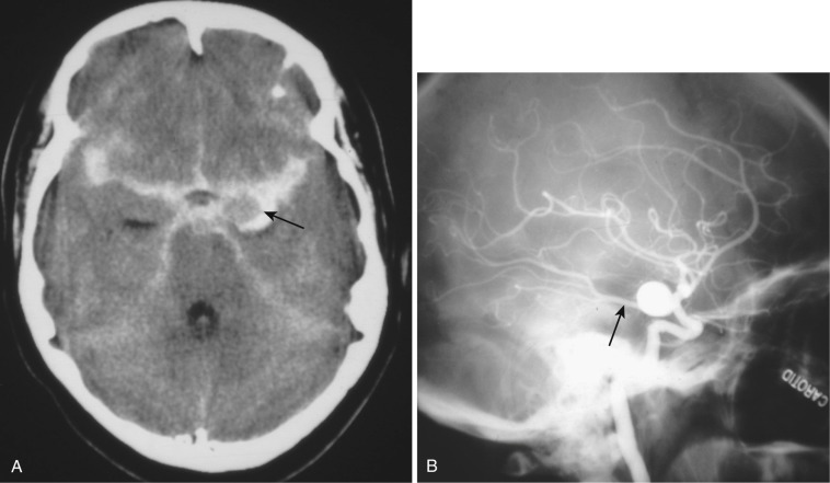FIG 12-20, A, CT image depicting a left posterior communicating aneurysm (arrow) set in negative relief by surrounding subarachnoid hemorrhage. B, Lateral view of the accompanying left carotid cerebral angiogram illustrating the left posterior communicating aneurysm adjacent to the left posterior cerebral artery having a fetal origin from the left internal carotid artery (arrow).