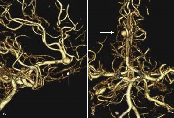 FIG 12-2, Reconstructed 3D CTA in ( A ) lateral and ( B ) frontal projections demonstrating an azygous A3 segment aneurysm (arrows).