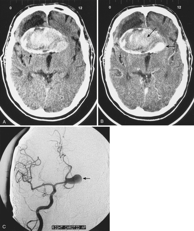 FIG 12-21, CT examination demonstrating calcification and old thrombus within a giant anterior communicating aneurysm. A, CT scan without contrast documenting calcification within the wall of the aneurysm wall (arrow). B, CT study with contrast demonstrating the contrast-enhancing patent lumen (short arrow) and the majority of the aneurysm filled with thrombus (long arrow). C, AP view of the right carotid angiogram illustrating the patent portion of the anterior communicating aneurysm (arrow) that is much smaller than its total volume.