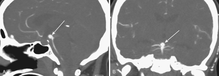 FIG 12-22, CTA of a basilar summit aneurysm (arrow). A, Sagittal reconstruction. B, Coronal reconstruction.