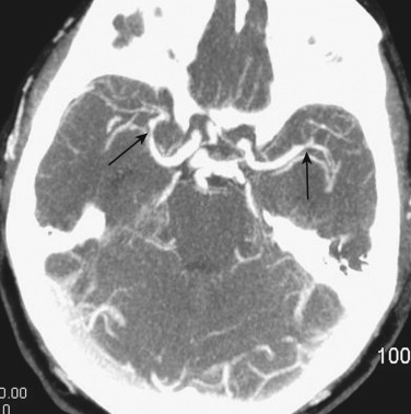 FIG 12-23, CTA demonstrating bilateral middle cerebral artery vasospasm (arrows) in a patient with recent subarachnoid hemorrhage.