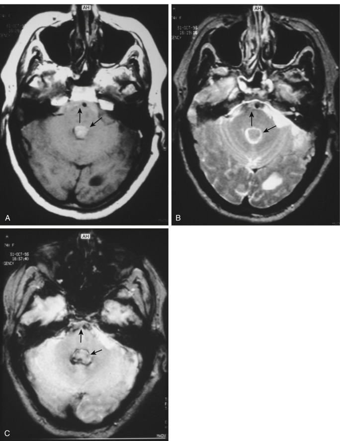 FIG 12-25, Acute subarachnoid hemorrhage within the prepontine cistern (anterior arrow) and acute intraventricular hemorrhage in the fourth ventricle (oblique arrow) on T1-weighted ( A ), T2-weighted ( B ), and T2* gradient echo ( C ) axial MRIs.