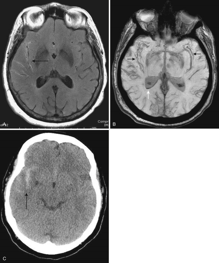FIG 12-26, T2-weighted FLAIR ( A ), SWI ( B ), and CT scan ( C ) demonstrating acute subarachnoid hemorrhage (black arrows) in a patient with a ruptured right posterior communicating aneurysm. The white arrow in B illustrates the sensitivity of SWI to intraventricular hemorrhage.
