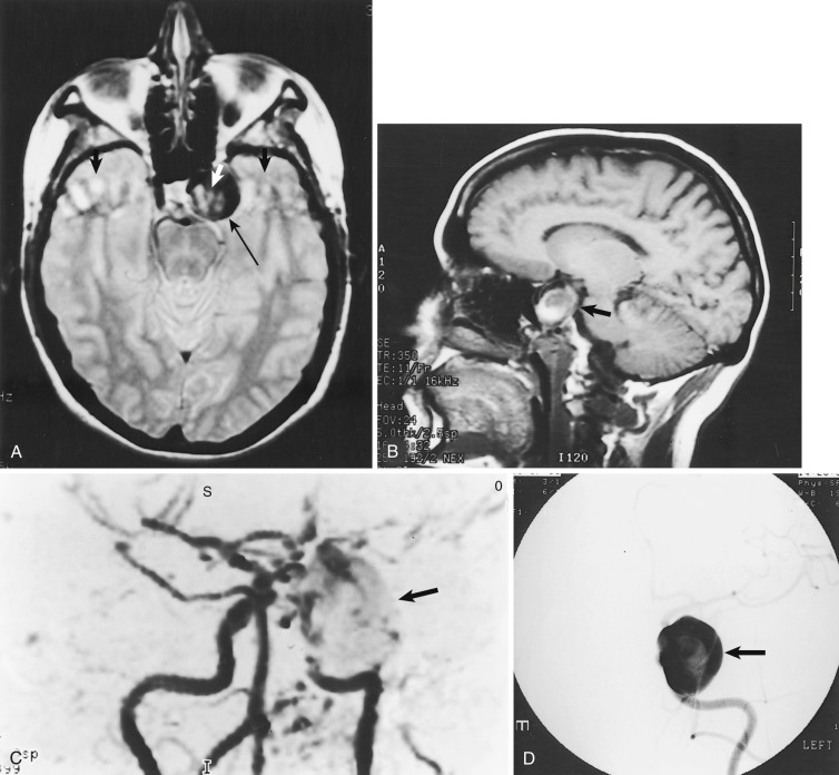 FIG 12-27, MRI and MRA examination demonstrating flow effects associated with a giant left cavernous carotid aneurysm. A, Axial short-TE, long-TR MRI demonstrating the aneurysm (long arrow), with internal and external phase-encoding artifact (short arrows) resulting from mismapped flow. B, Sagittal T1-weighted image falsely gives the appearance of thrombus within the aneurysm (arrow) owing to slow flow. C, 3D time-of-flight (TOF) MRA poorly outlines the aneurysm (arrow) because of internal slow flow. D, AP view of left carotid angiogram confirms giant left cavernous carotid aneurysm (arrow).