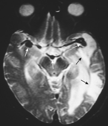 FIG 12-28, Axial T2-weighted MRI demonstrating chronic left middle cerebral artery territory infarctions (black arrows) in a patient with bilateral middle cerebral (mirror aneurysms) and basilar summit aneurysms (white arrows). Same case as illustrated in Figure 12-29 .