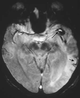 FIG 12-29, Flow artifact (long arrow) within a left middle cerebral aneurysm on an axial T2* gradient echo MRI. Note the left temporal lobe cortical hemosiderin (short arrow) in a chronic infarction. Same case as illustrated in Figure 12-28 .