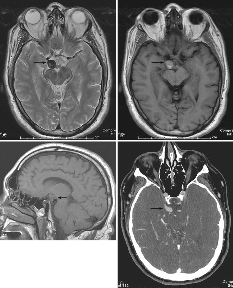 FIG 12-30, Acute thrombus within a dissecting right posterior communicating pseudoaneurysm shown on ( A ) axial T2-weighted MRI (arrow), axial ( B ) (arrow), and sagittal ( C ) (arrow) T1-weighted MRI, with a patent lumen located posteriorly and inferiorly on the sagittal study and axial CTA scan ( D ) (arrow) . More cephalad CTA image ( E ) confirms the thrombosed component of the pseudoaneurysm (arrow). The patient presented with headache without subarachnoid hemorrhage and was treated with aspirin. F and G, Two sequential lateral views of the catheter right carotid cerebral angiogram acquired 1 month later illustrate the thrombus has resorbed and the pseudoaneurysm is now completely patent (arrows). Note the swirling pattern of flow within the pseudoaneurysm in F.