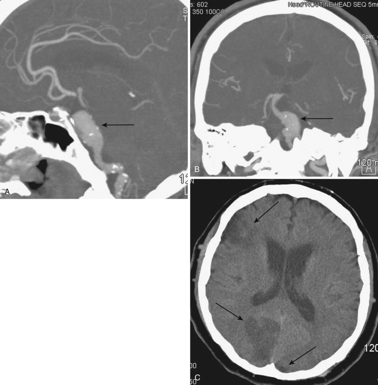 FIG 12-3, Sagittal ( A ) and coronal ( B ) individual slice reconstructions of a CTA demonstrating an atherosclerotic fusiform basilar aneurysm (arrow). Note the calcification within the wall of the aneurysm. C, Axial noncontrast CT scan illustrating an acute right occipital infarction, a small chronic left occipital infarction, and an unrelated chronic right frontal infarction (arrows). The occipital infarctions may be secondary to emboli from the atherosclerotic fusiform basilar aneurysm.