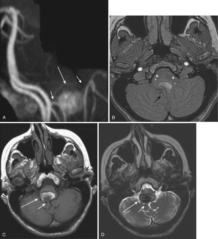 FIG 12-31, A, Reconstructed noncontrast MRA of a stented right posterior inferior cerebellar artery (PICA) dissecting pseudoaneurysm. Subacute thrombosis of the majority of the pseudoaneurysm results in increased signal intensity on the TOF MRA (long arrow); however, the proximal and distal portions of the right PICA are patent with good flow (short arrows). B, Axial source image of the MRA documents patency of the right PICA, with peripheral diminished signal intensity caused by the Neuroform microstent (Boston Scientific Corp.) (arrow), and no flow in the pseudoaneurysm. Axial noncontrast T1-weighted ( C ) and axial T2-weighted ( D ) MRIs confirming patency of the right PICA (short arrow) and both subacute and acute thrombus in the right PICA dissecting pseudoaneurysm (long arrow). Note the edema in the medulla on the T2-weighted image. E and F, Early and late arterial phase oblique lateral images of the right vertebral 3D rotational angiogram immediately after endovascular treatment, illustrating the proximal and distal markers of the Neuroform microstent ( arrows in E ) and the patent portion of the pseudoaneurysm that went on to thrombose ( arrow in F ).