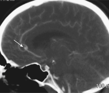 FIG 12-5, Sagittal CTA demonstrating a pericallosal aneurysm (arrow) in a cocaine user with an azygous A2 segment of the anterior cerebral arteries.