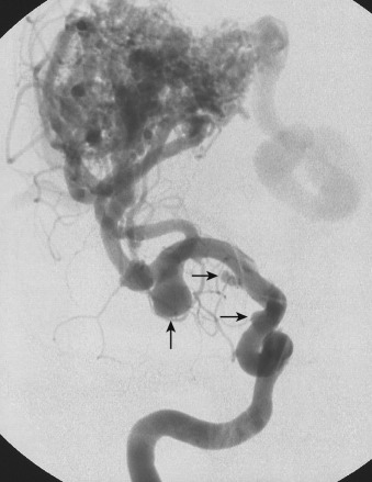 FIG 12-6, Catheter cerebral angiogram, AP view, of a right middle cerebral territory AVM with three flow-related aneurysms (arrows).