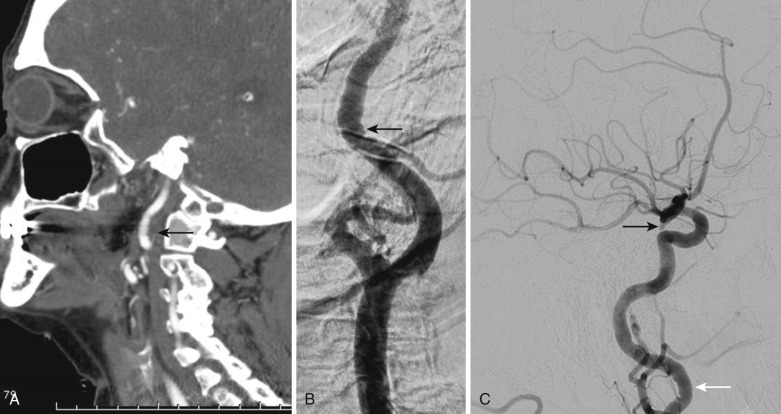 FIG 12-7, Woman with carotid fibromuscular dysplasia seen on the CTA sagittal reconstruction of the left carotid ( arrow in A ), better illustrated on the cervical lateral view of the catheter left carotid angiogram ( arrow in B ), and also indicated in the right carotid artery on the lateral right carotid cerebral angiogram ( white arrow in C ) that also demonstrates a small ruptured right posterior communicating aneurysm ( black arrow in C ).