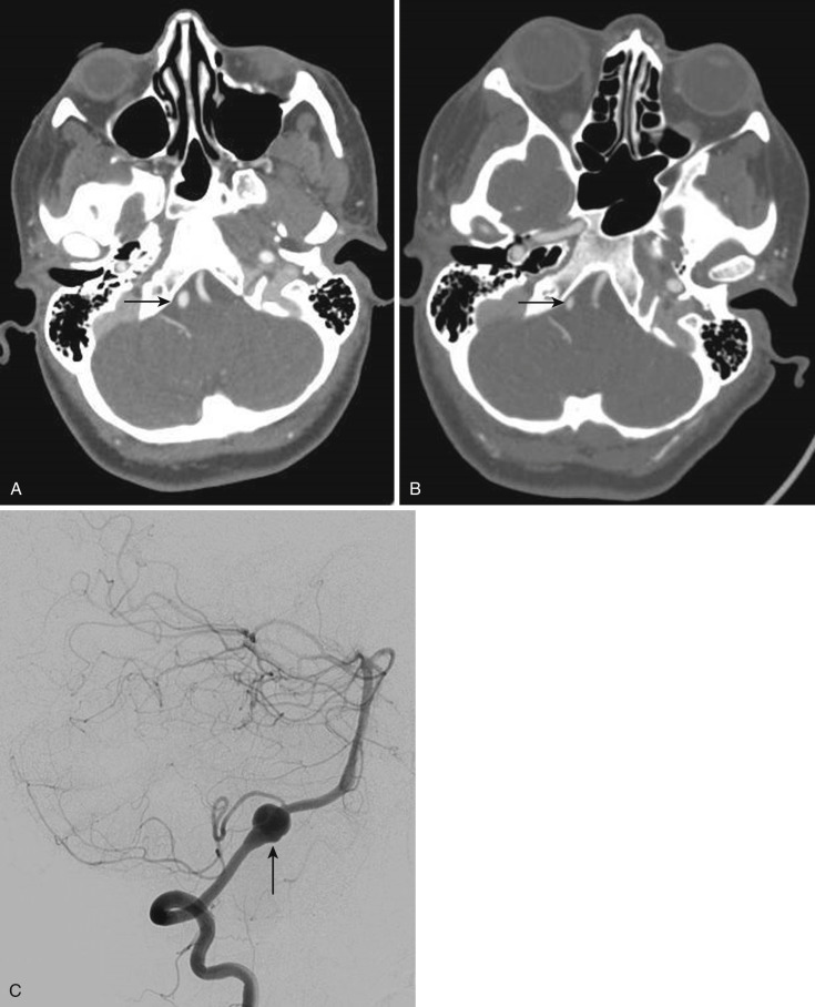FIG 12-8, Patient with genetically confirmed Ehlers-Danlos syndrome and new-onset headache. A, Axial CTA section documenting a new pseudoaneurysm (arrow) involving the subarachnoid intracranial right vertebral artery, not seen on a prior CTA ( B ) (arrow). Note the interval apparent vertebral artery lumen enlargement. C, Lateral oblique view of the right vertebral cerebral catheter angiogram confirming the pseudoaneurysm (arrow) located proximal to posterior inferior cerebellar artery (PICA). The widened vertebral artery segment proximal to the pseudoaneurysm indicates this is a dissection.