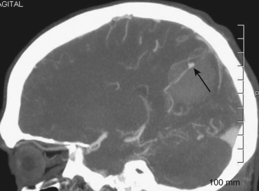FIG 12-9, CTA demonstrating a distal posterior cerebral artery territory mycotic pseudoaneurysm (arrow) with adjacent parenchymal hematoma in a patient with mitral valve vegetations.