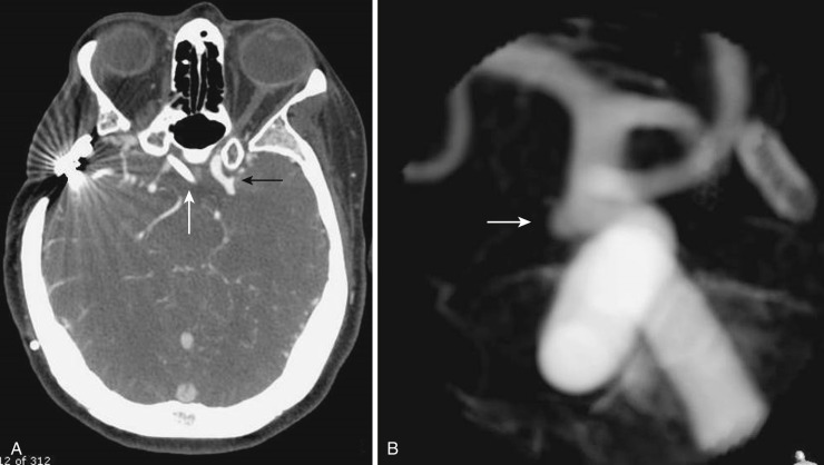 FIG 12-10, Axial image of a CTA ( A ) revealing a small left supraclinoid carotid segment aneurysm (black arrow) that had produced subarachnoid hemorrhage in a patient with previous radiation therapy for a suprasellar mass as a child. Note the right craniotomy and right suprasellar subarachnoid catheter (white arrow). B, 3D reconstruction image from a rotational left carotid catheter cerebral angiogram confirms the aneurysm (arrow).