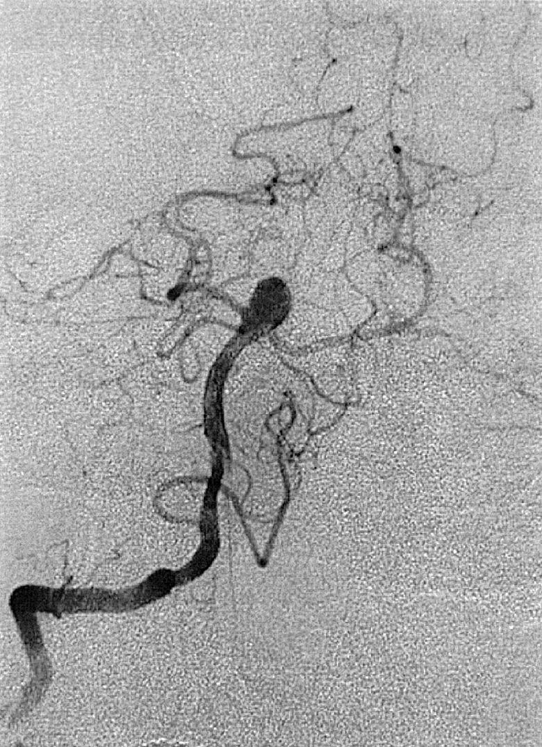 Fig. 49.12, Right vertebral artery injection, frontal projection, arterial phase, demonstrating a basilar tip aneurysm.