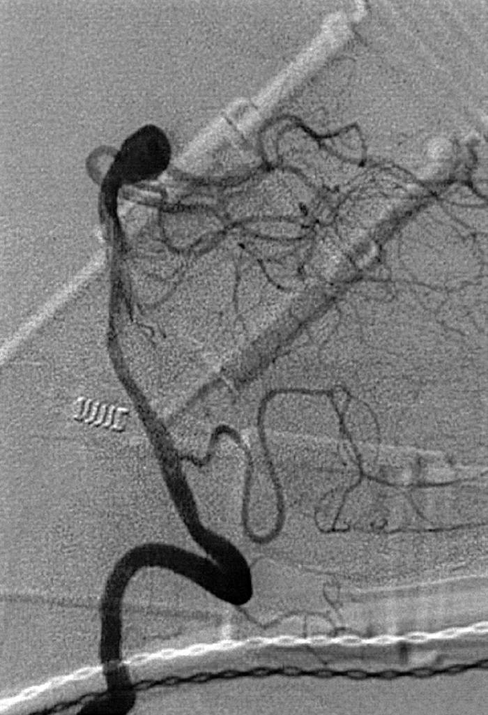 Fig. 49.13, Vertebral artery injection, lateral projection, arterial phase, demonstrating a basilar tip aneurysm.