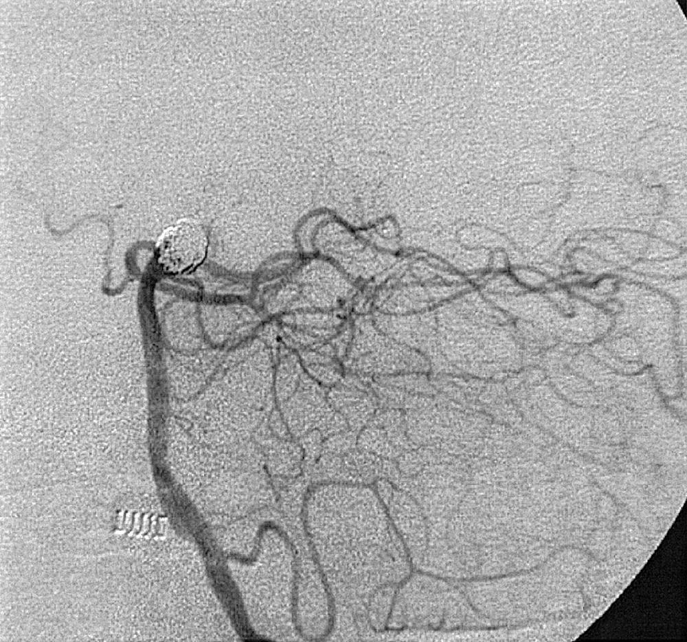 Fig. 49.14, Lateral projection, posterior circulation, arterial phase. Status: postembolization; the basilar tip aneurysm is no longer opacifying.