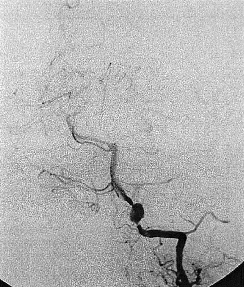 Fig. 49.15, Vertebral artery injection, frontal projection, demonstrating a vertebrobasilar aneurysm. Notice how the contrast column rapidly narrows and there is significantly decreased opacification of the vasculature distal to the aneurysm. This is consistent with a dissecting aneurysm.