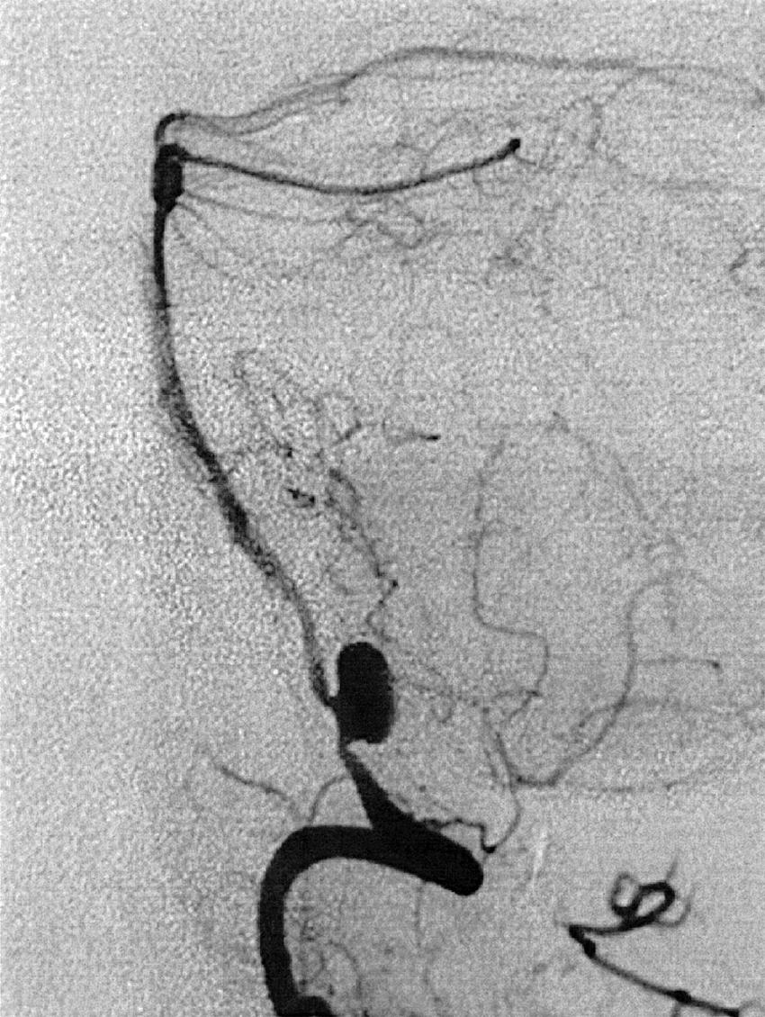 Fig. 49.16, Vertebral artery injection, lateral projection, arterial phase, demonstrating a dissecting vertebrobasilar aneurysm.