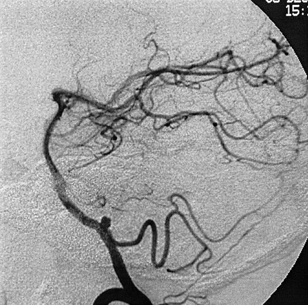 Fig. 49.17, Vertebral artery injection, lateral projection, arterial phase, demonstrating a posterior, inferior, cerebellar artery aneurysm.