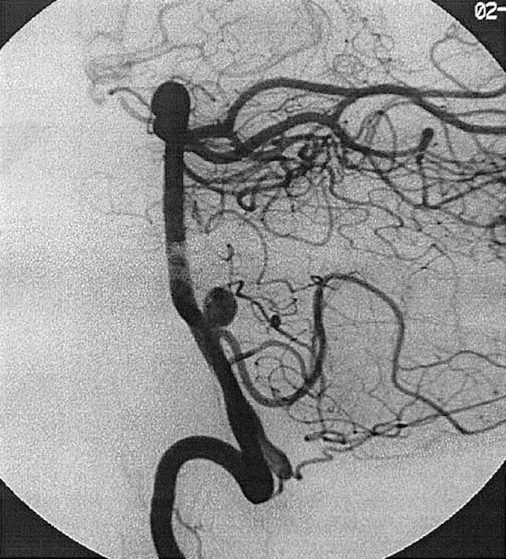 Fig. 49.18, Vertebral artery injection, lateral projection, arterial phase, demonstrating both a basilar tip aneurysm and a posterior, inferior, cerebellar artery aneurysm.