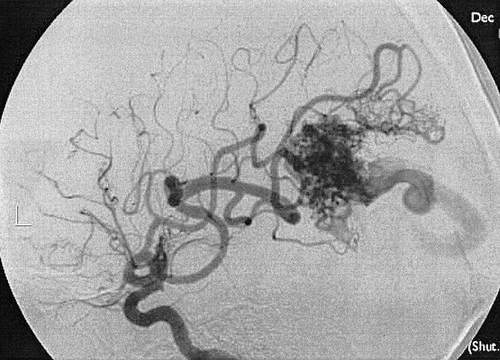 Fig. 49.19, Internal carotid artery injection, lateral projection, arterial phase, demonstrating early venous opacification, as well as a nidus, consistent with an arteriovenous malformation.