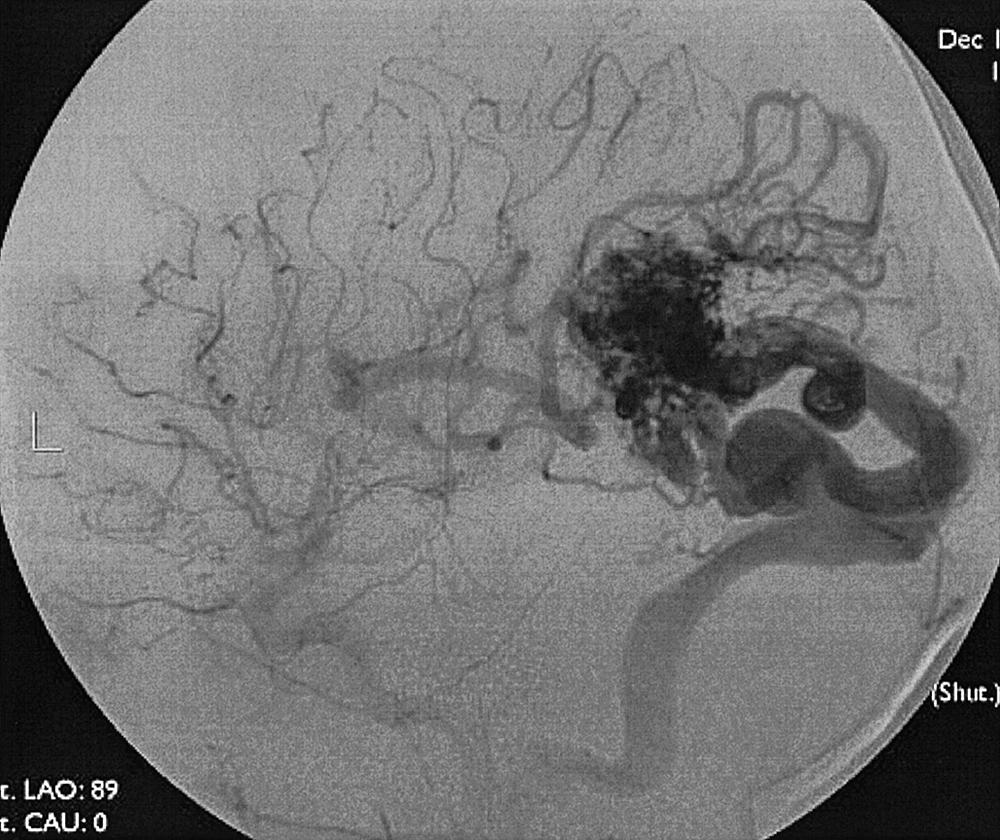 Fig. 49.20, Internal carotid artery injection, lateral projection, venous phase, demonstrating the venous phase of an arteriovenous malformation. Note the enlarged vein draining the arteriovenous malformation nidus.