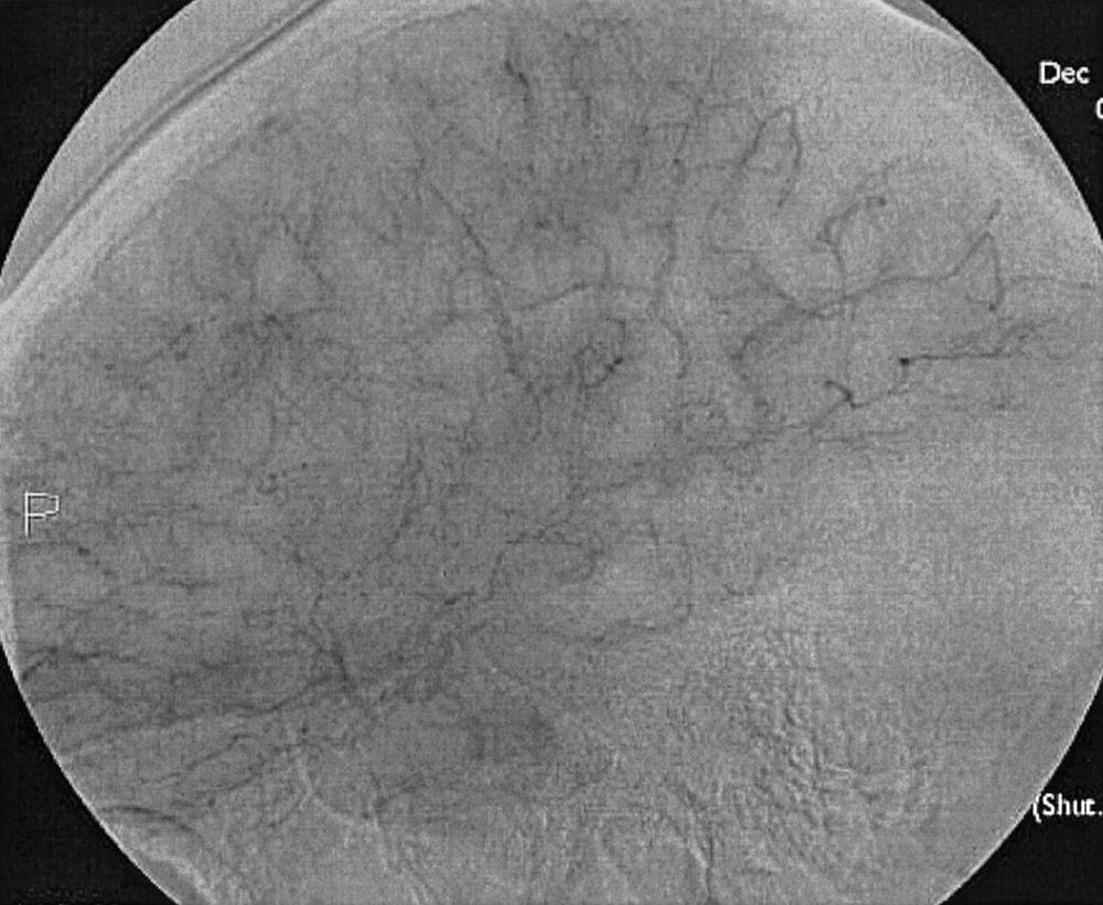 Fig. 49.2, Internal carotid artery injection, lateral projection, capillary phase. No significant arterial or venous opacification is noted during this phase.