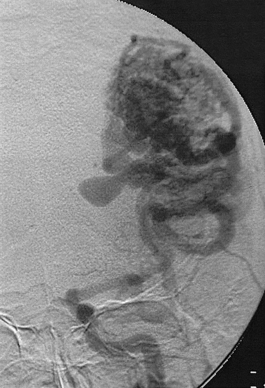 Fig. 49.21, Left internal carotid artery injection, anteroposterior projection, arterial phase, demonstrating an enlarged middle cerebral artery vasculature feeding an arteriovenous malformation with an aneurysm whose dome points inferomedially.