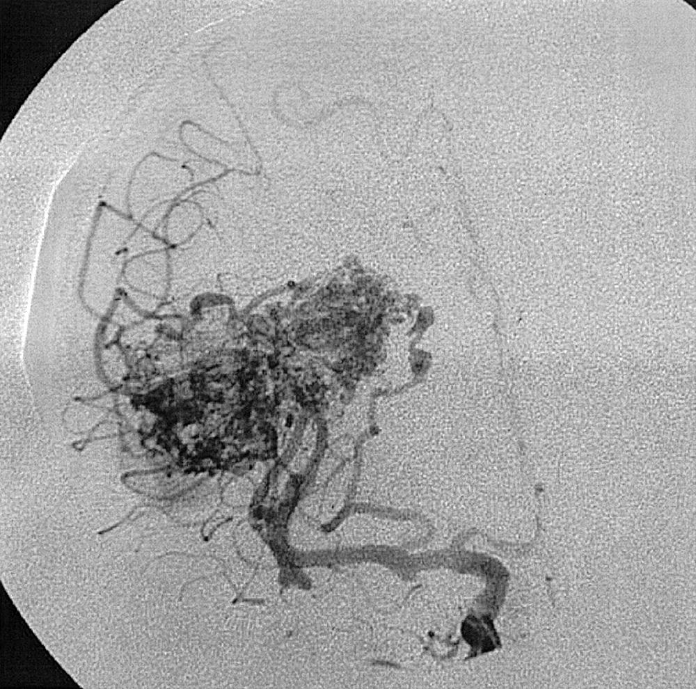 Fig. 49.22, Right internal carotid artery injection, frontal projection, arterial phase, demonstrating an arteriovenous malformation being opacified by middle cerebral arterial vessels, as well as a lenticulostriate artery originating from the M1 segment of the middle cerebral artery.