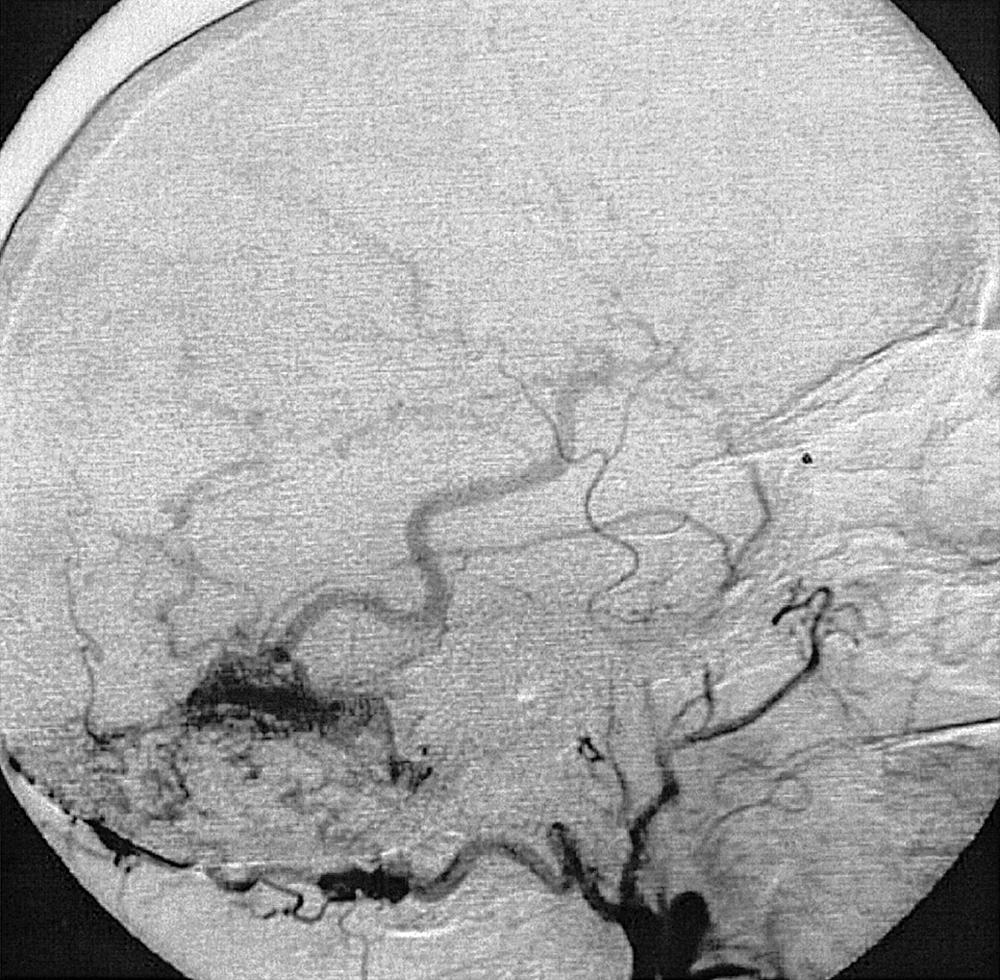 Fig. 49.5, External carotid artery injection, lateral projection. There is arterial and early venous opacification with contrast simultaneously. The dural fistula is also opacified.