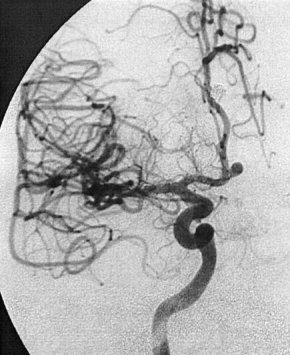 Fig. 49.6, Right internal carotid artery injection, frontal projection, demonstrates an anterior communicating artery aneurysm. The aneurysm dome points superomedially.