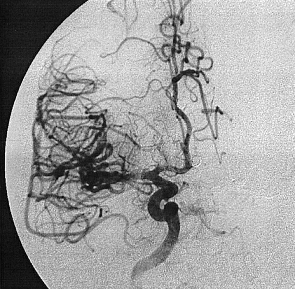 Fig. 49.7, Right internal carotid artery injection, anteroposterior projection, after embolization. The anterior communicating artery aneurysm seen previously is no longer opacifying.