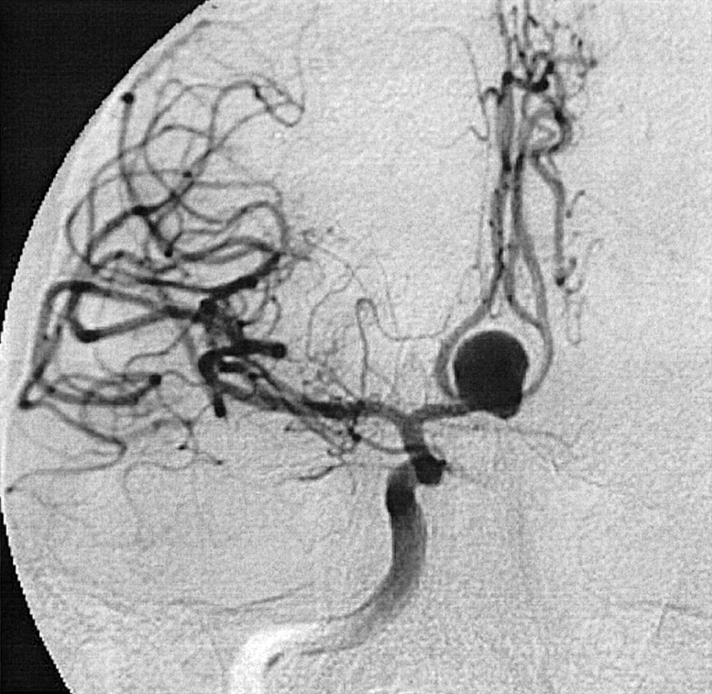 Fig. 49.8, Right internal carotid artery injection, frontal view, arterial phase, demonstrating a large anterior communicating artery aneurysm. Notice how the A2 segments of the anterior cerebral artery are splayed by the aneurysm.